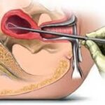 تنظيف الرحم